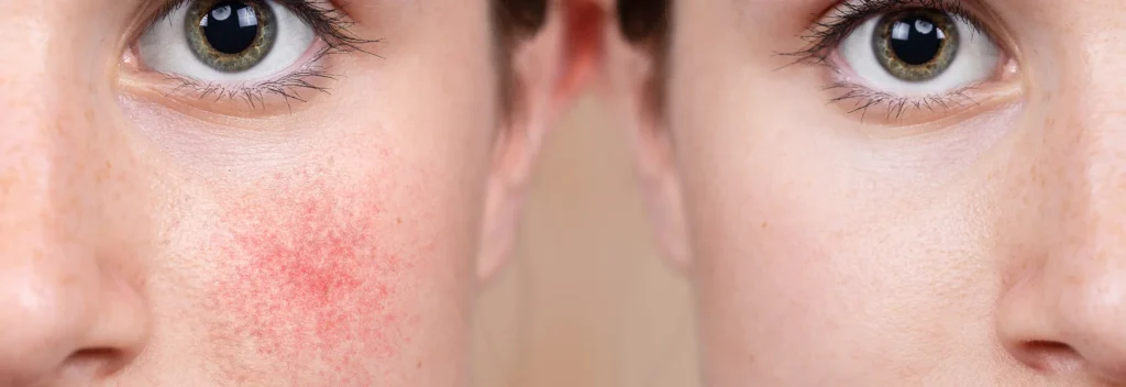 dermatologie rosazea 2400x824px
